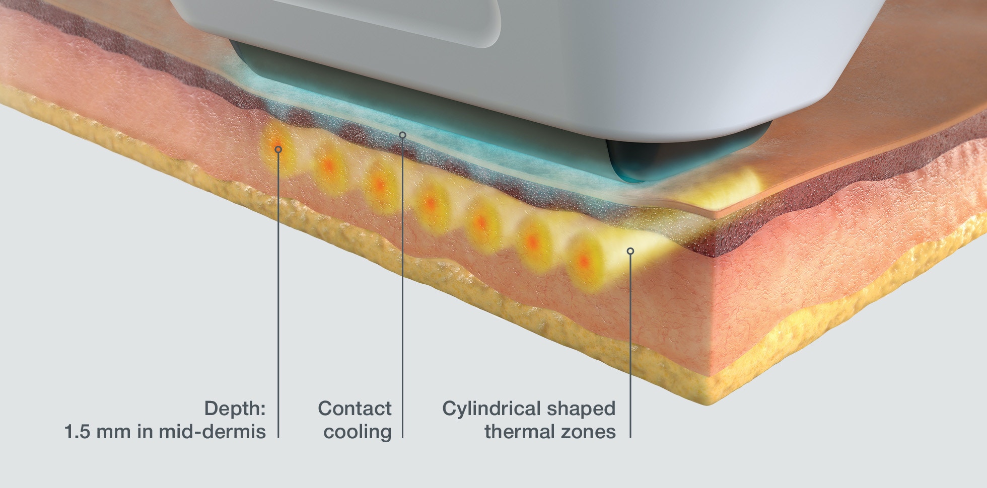 sofwave skin diagram
