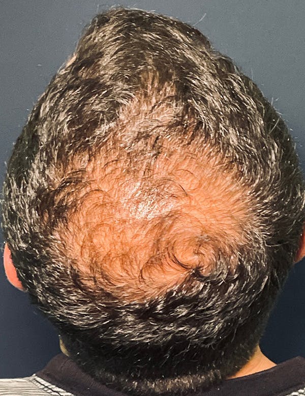 Exosomes/ExoBoost Before & After Gallery - Patient 398190 - Image 1