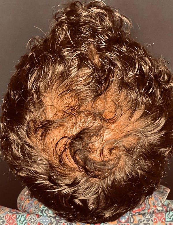 Exosomes/ExoBoost Before & After Gallery - Patient 398190 - Image 2