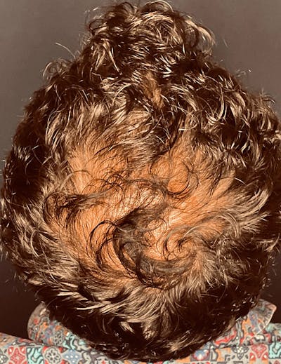 Exosomes/ExoBoost Before & After Gallery - Patient 398190 - Image 2