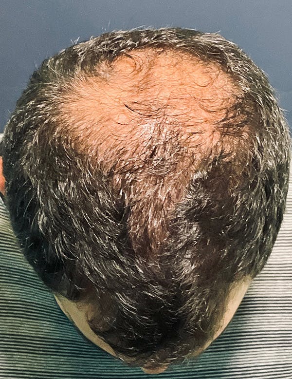Exosomes/ExoBoost Before & After Gallery - Patient 398190 - Image 3