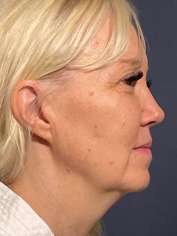 Facelift Before & After Gallery - Patient 566085 - Image 5