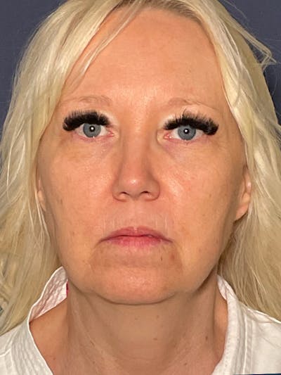 Facelift Before & After Gallery - Patient 566085 - Image 1