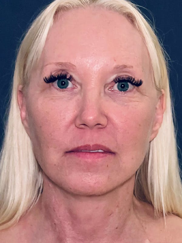 Facelift Before & After Gallery - Patient 566085 - Image 2
