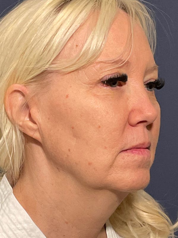 Facelift Before & After Gallery - Patient 566085 - Image 3