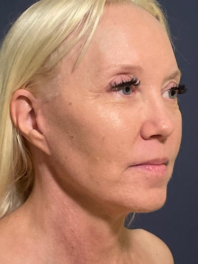 Facelift Before & After Gallery - Patient 566085 - Image 4