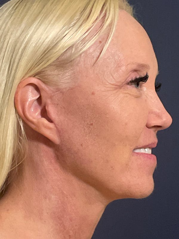 Facelift Before & After Gallery - Patient 566085 - Image 6