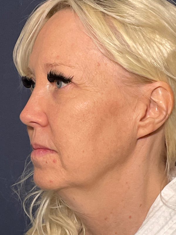 Facelift Before & After Gallery - Patient 566085 - Image 7