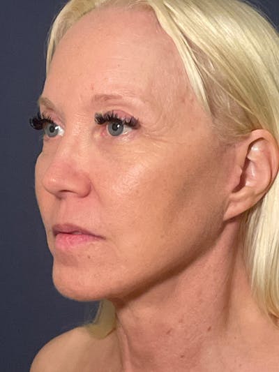 Facelift Before & After Gallery - Patient 566085 - Image 8