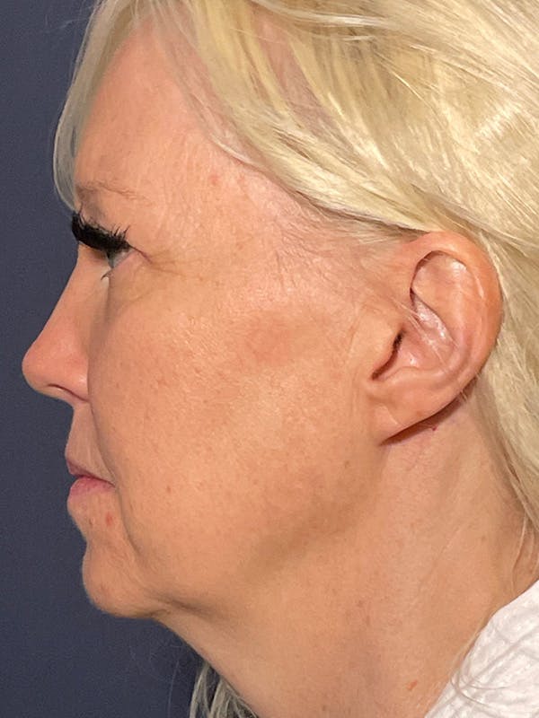 Facelift Before & After Gallery - Patient 566085 - Image 9