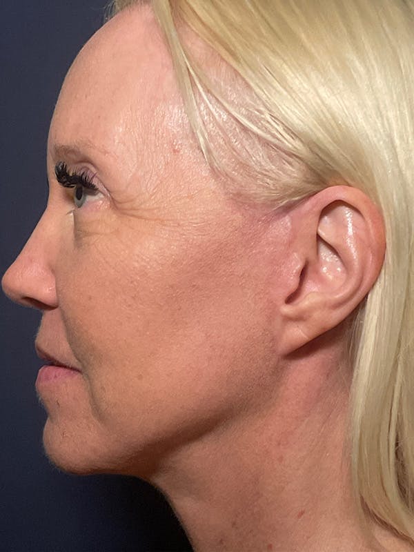 Facelift Before & After Gallery - Patient 566085 - Image 10