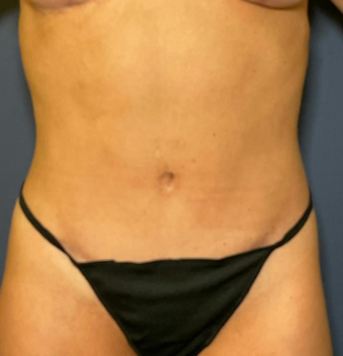 Tummy Tuck (Abdominoplasty) Before & After Gallery - Patient 377466 - Image 2
