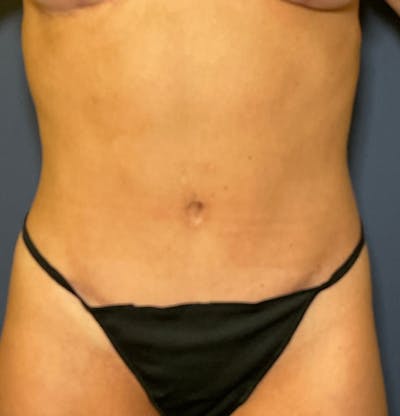 Tummy Tuck (Abdominoplasty) Before & After Gallery - Patient 377466 - Image 2