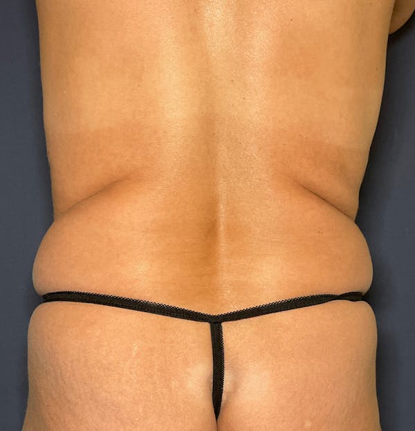 Tummy Tuck (Abdominoplasty) Before & After Gallery - Patient 377466 - Image 5