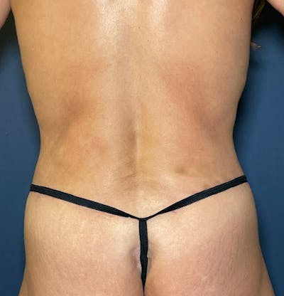 Tummy Tuck (Abdominoplasty) Before & After Gallery - Patient 377466 - Image 6