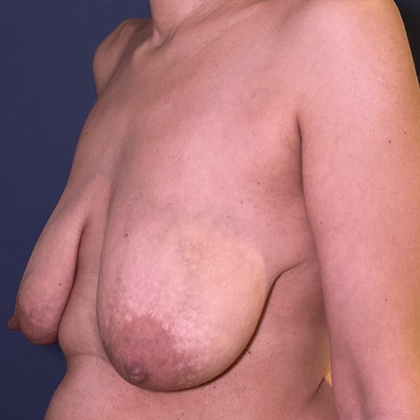 NaturaBra® Mastopexy Before & After Gallery - Patient 272864 - Image 7