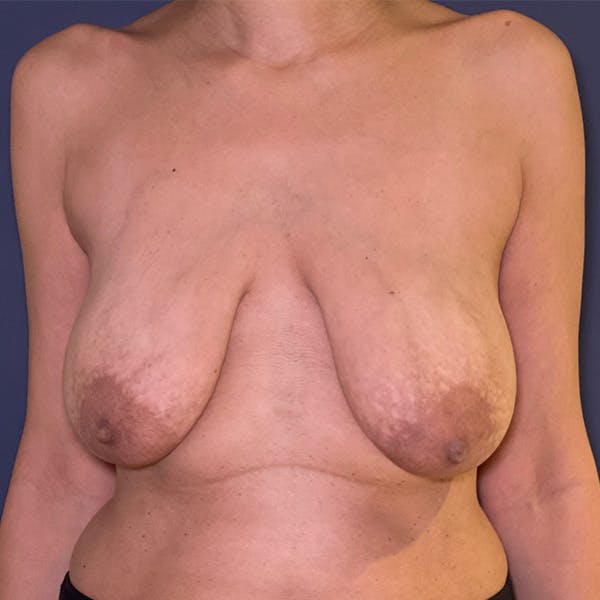 NaturaBra® Mastopexy Before & After Gallery - Patient 272864 - Image 1