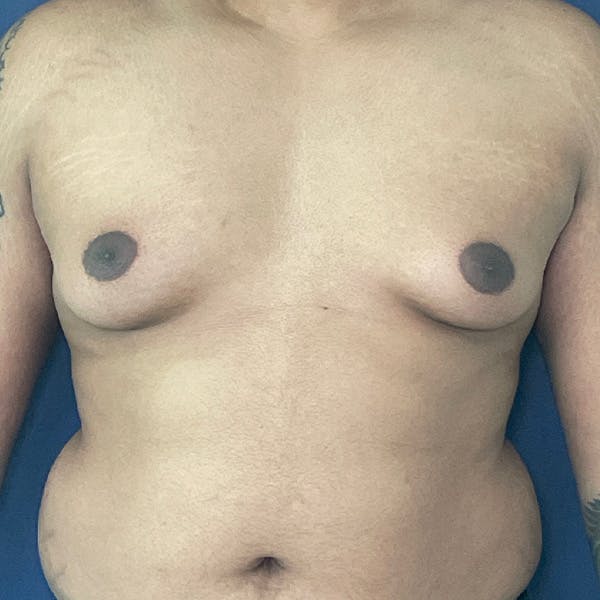 Gynecomastia (Male Breast Reduction) Before & After Gallery - Patient 146362408 - Image 1