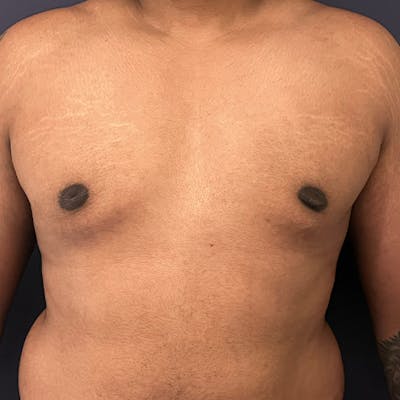 Gynecomastia (Male Breast Reduction) Before & After Gallery - Patient 146362408 - Image 2