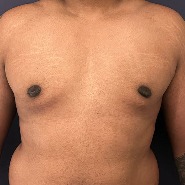 Gynecomastia (Male Breast Reduction) Before & After Gallery - Patient 146362408 - Image 2