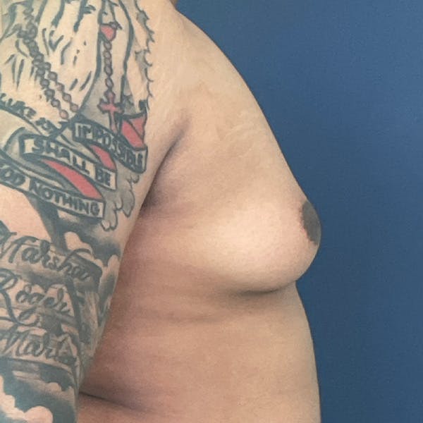 Gynecomastia (Male Breast Reduction) Before & After Gallery - Patient 146362408 - Image 3