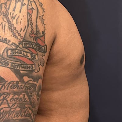 Gynecomastia (Male Breast Reduction) Before & After Gallery - Patient 146362408 - Image 4
