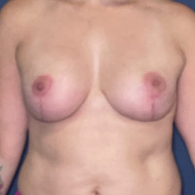 Breast Reduction Before & After Gallery - Patient 149191843 - Image 2
