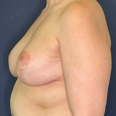 Breast Reduction Before & After Gallery - Patient 149191843 - Image 6
