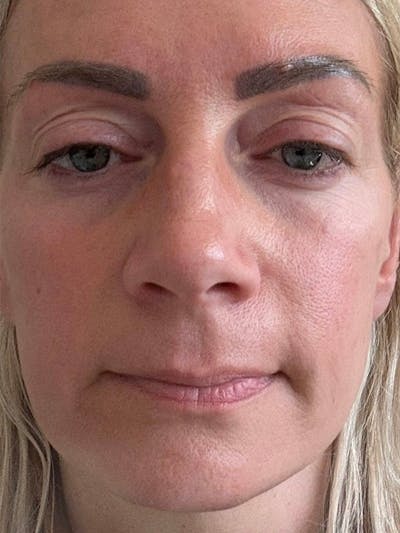 NaturaBrow® Before & After Gallery - Patient 318820 - Image 1