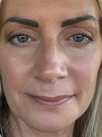 Blepharoplasty (Eyelid Surgery) Before & After Gallery - Patient 335197 - Image 2