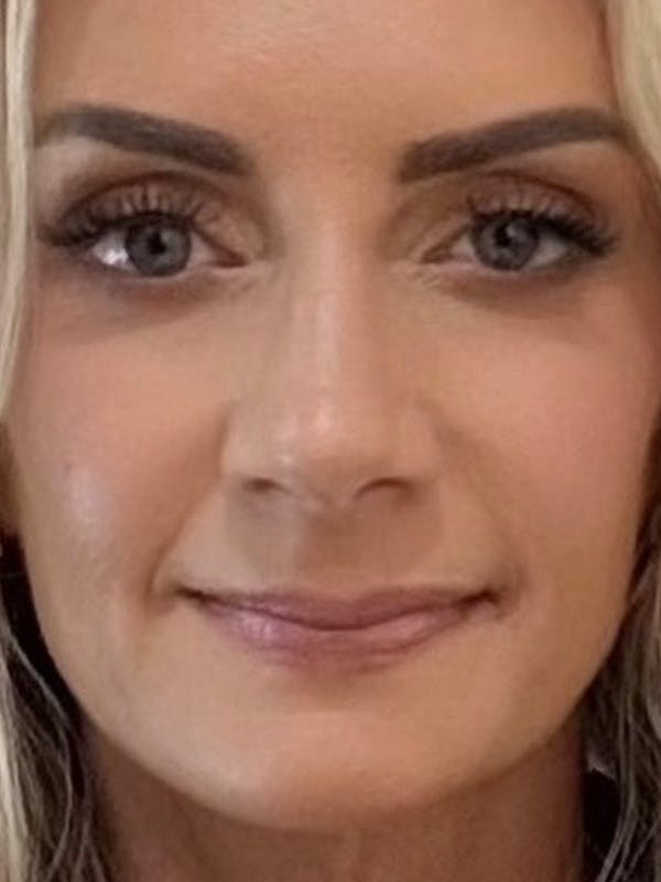 Blepharoplasty (Eyelid Surgery) Before & After Gallery - Patient 335197 - Image 4