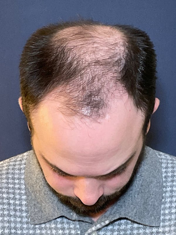 FUE Before & After Gallery - Patient 423366 - Image 3