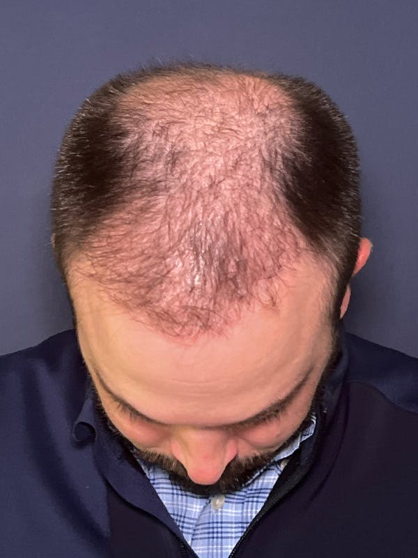 FUE Before & After Gallery - Patient 423366 - Image 4