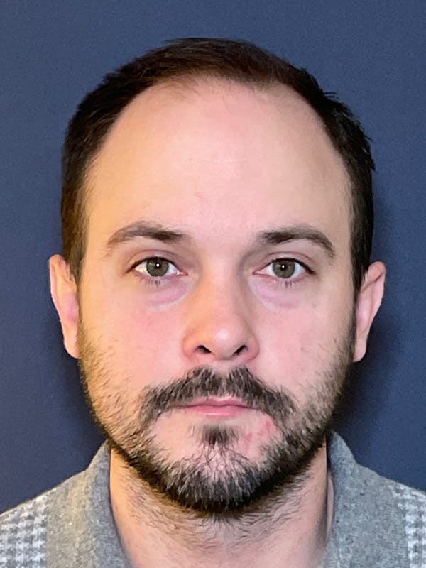 FUE Before & After Gallery - Patient 423366 - Image 1