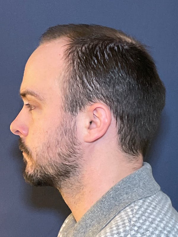 FUE Before & After Gallery - Patient 423366 - Image 5