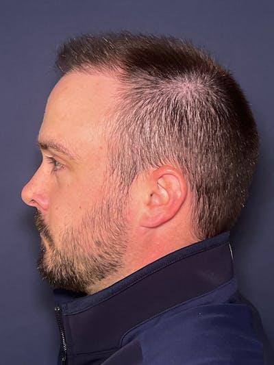FUE Before & After Gallery - Patient 423366 - Image 6