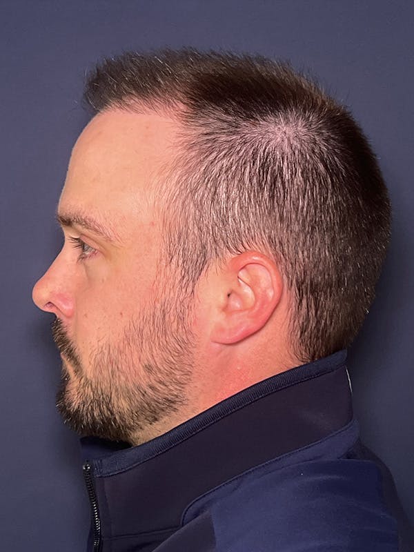 FUE Before & After Gallery - Patient 423366 - Image 6