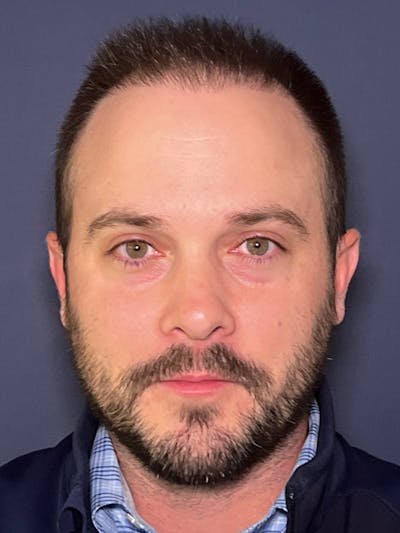 FUE Before & After Gallery - Patient 423366 - Image 2