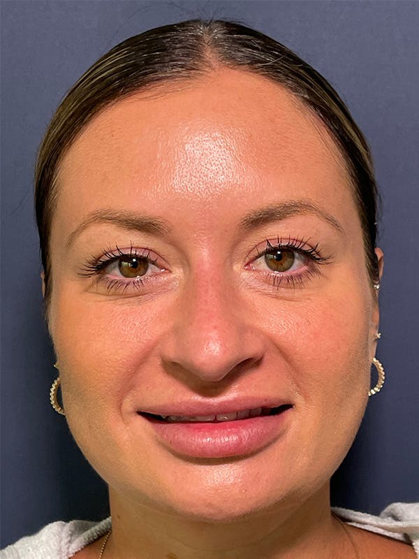  Liquid Rhinoplasty Before & After Gallery - Patient 381322 - Image 5