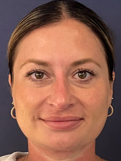  Liquid Rhinoplasty Before & After Gallery - Patient 381322 - Image 6