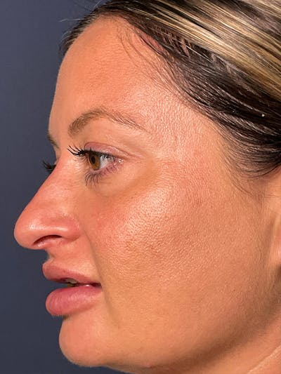  Liquid Rhinoplasty Before & After Gallery - Patient 381322 - Image 1