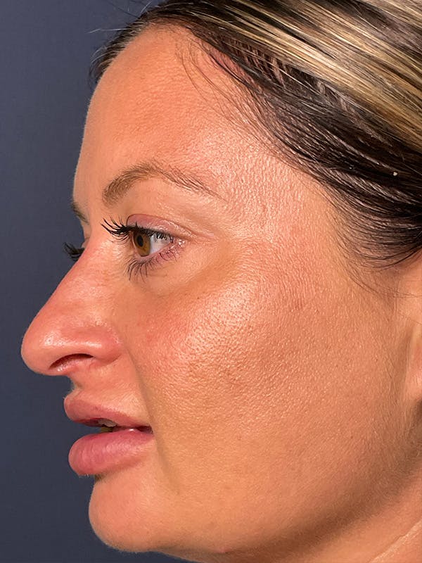  Liquid Rhinoplasty Before & After Gallery - Patient 381322 - Image 1