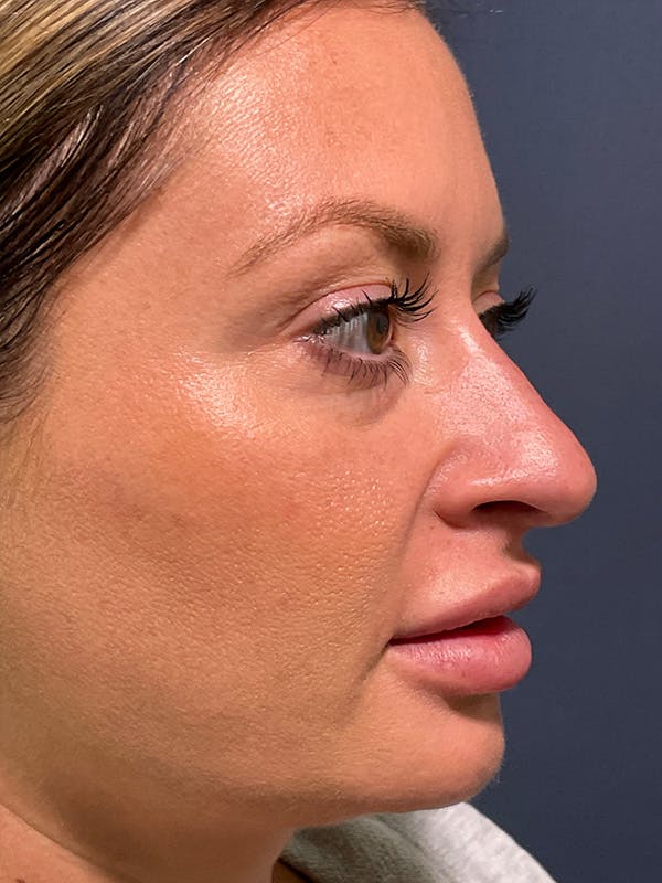  Liquid Rhinoplasty Before & After Gallery - Patient 381322 - Image 3