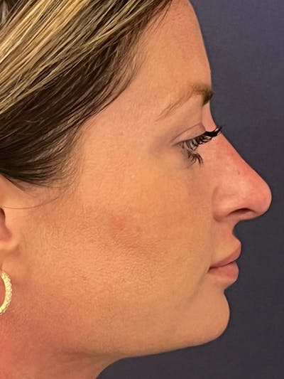  Liquid Rhinoplasty Before & After Gallery - Patient 381322 - Image 4