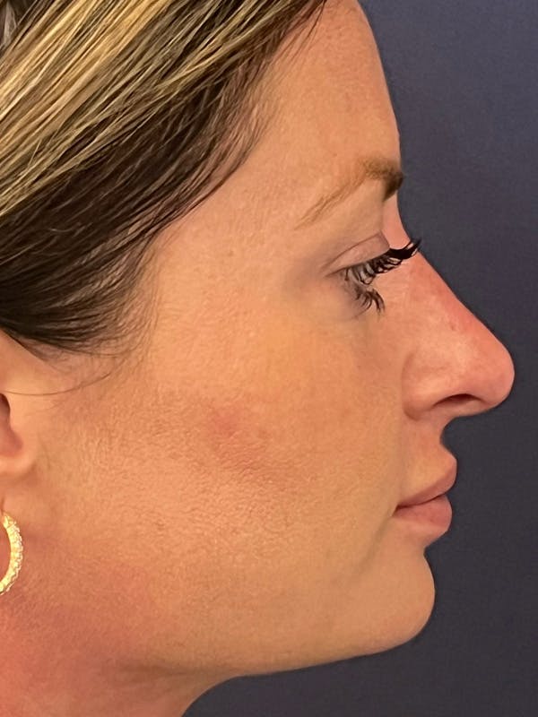  Liquid Rhinoplasty Before & After Gallery - Patient 381322 - Image 4