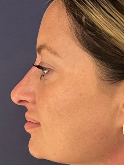  Liquid Rhinoplasty Before & After Gallery - Patient 381322 - Image 2