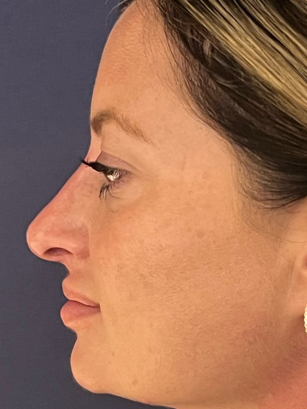  Liquid Rhinoplasty Before & After Gallery - Patient 381322 - Image 2