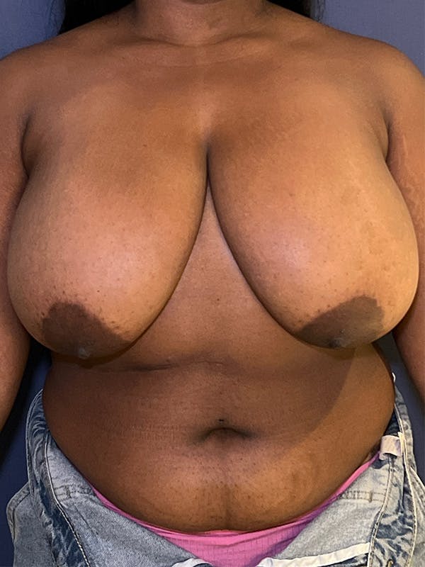 Breast Reduction Before & After Gallery - Patient 149191843 - Image 1