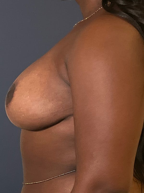 Breast Reduction Before & After Gallery - Patient 149191843 - Image 4