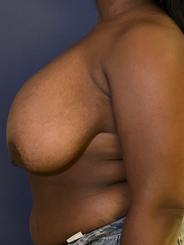 Breast Reduction Before & After Gallery - Patient 149191843 - Image 3
